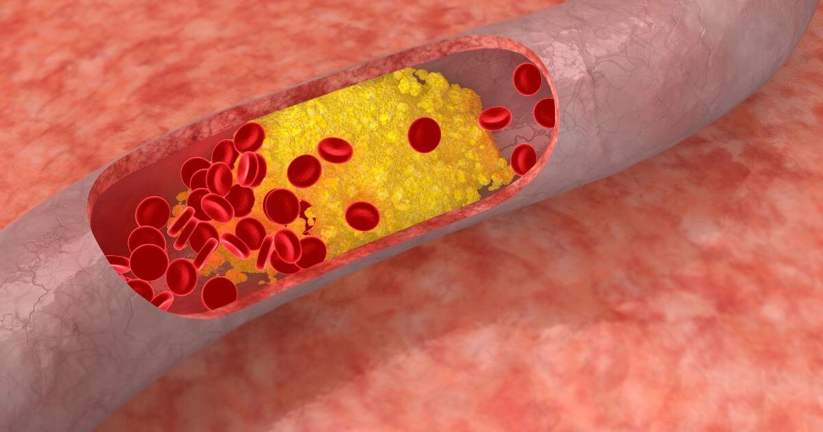 Verstopfte Arterie mit Cholesterinablagerungen und roten Blutkörperchen