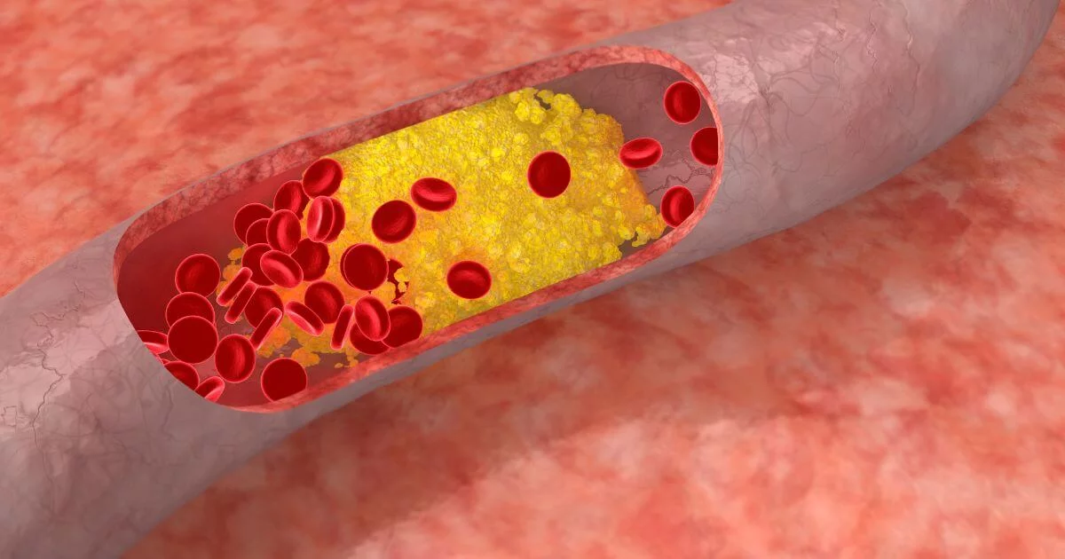 Cholesterin senken Verstopfte Arterie mit Cholesterinablagerungen und roten Blutkörperchen