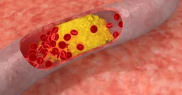 Cholesterin in wenigen Wochen senken – natürlich, sicher und einfach