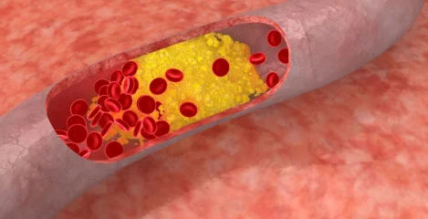 Verstopfte Arterie mit Cholesterinablagerungen und roten Blutkörperchen